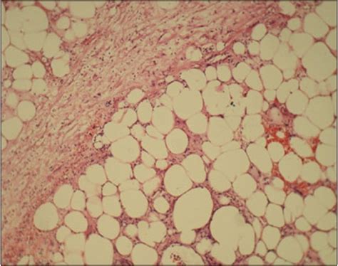 Slide 1 Histopathology Slide From Lipoma Showing Adiposetissue With