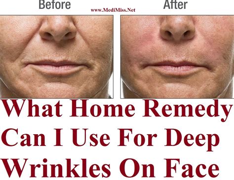 What Home Remedy Can I Use For Deep Wrinkles On Face