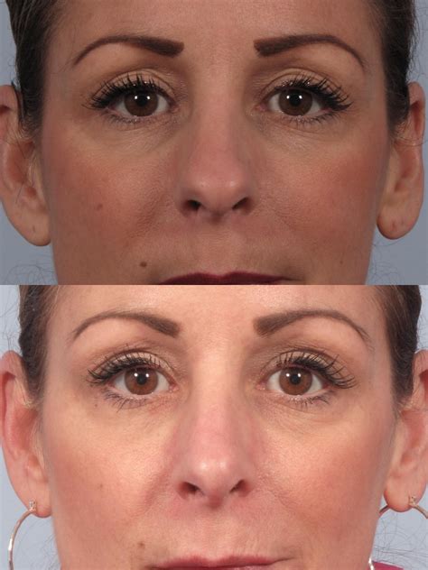 Nose Shaping With Surgery Or Nose Filler Dr Brett Kotlus Cosmetic