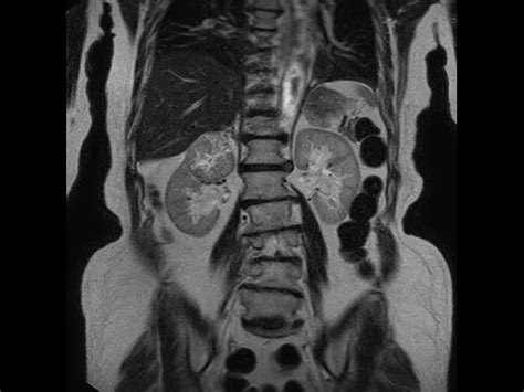 Kidney Imaging Free Breathing Philips Mr Body Map