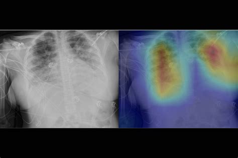 Radiologists Use Deep Learning To Find Signs Of Covid 19 In Chest X