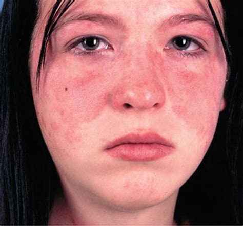 Skin Rashes Adults Images