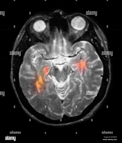 Una Resonancia Magnética Del Cerebro Que Muestra La Esclerosis Múltiple