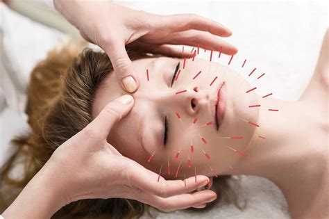 7 Things To Consider Before Embarking On A Career In Acupuncture