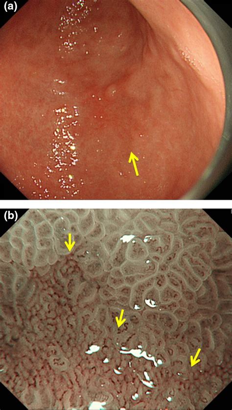 Guidelines For Endoscopic Diagnosis Of Early Gastric Cancer Yao Digestive Endoscopy
