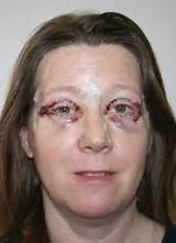 Photos of Lasik Eye Surgery Bruising