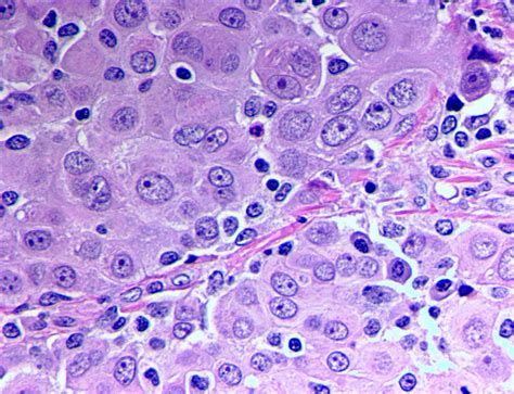 Pathology Outlines Mesothelioma Peritoneum Epithelioid