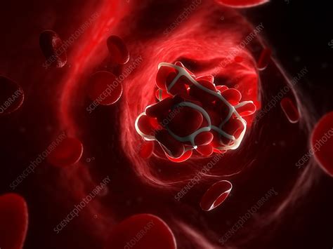 Blood Clot Artwork Stock Image F0043042 Science Photo Library