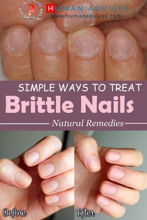 Simple Ways To Treat Brittle Nails Human Advices Brittle Nails