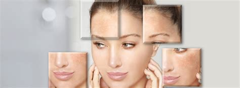 Skin Lightening Treatment Ofy
