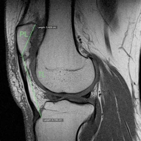 A Sagittal T1 Weighted Magnetic Resonance Image Mri Of The Right