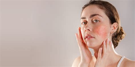 How To Get Rid Of Redness On Face Causes And Treatment