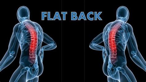 What Is Flatback Syndrome Restore Orthopedics And Spine Center