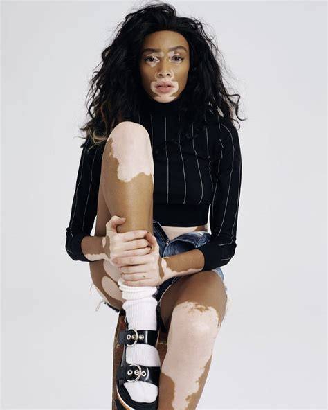 Women With Vitiligo Share Photos Of Themselves Revelist Winnie