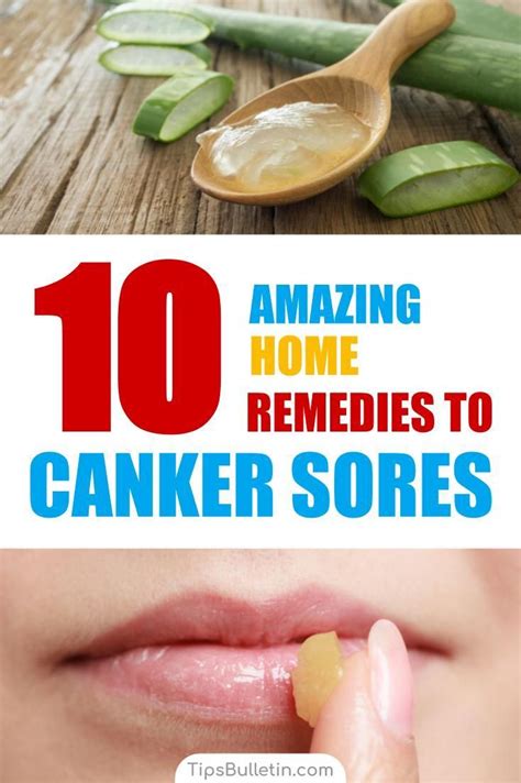 Canker Sore On Tongue Canker Sore Relief Canker Sore Causes Canker Sore Treatment Canker