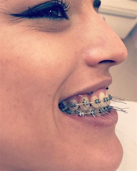 Braces Girlswithbraces Metalbraces Dental Braces Teeth Braces