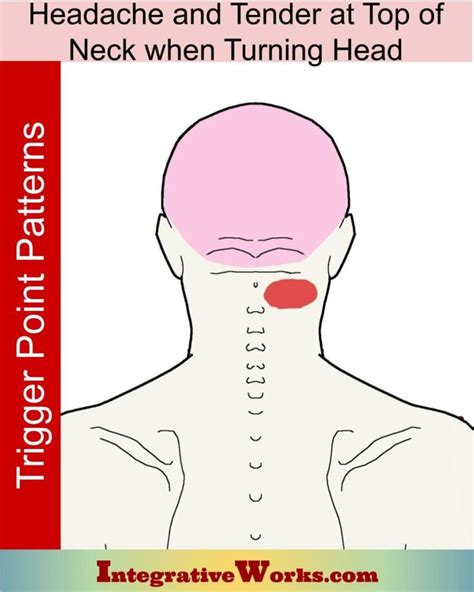 Headache With Tender Top Of Neck While Turning Knots In Neck Muscle
