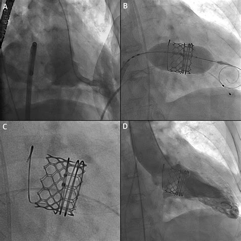 Percutaneous Transcatheter Mitral Valve Replacement First In Human