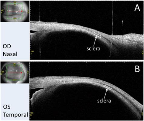 Anterior Segment Optical Coherence Tomography AS OCT Images Of The Download Scientific