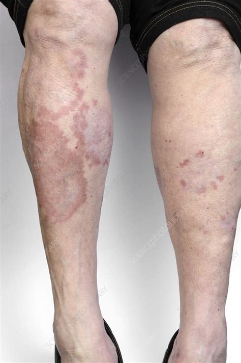 Granuloma Annulare On The Legs Stock Image C0166912 Science