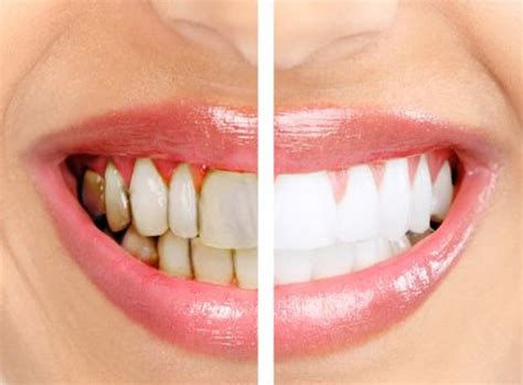 What Is Gingivitis Stonehill Dental Hamilton Dentist