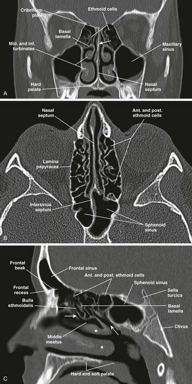 Nose And Sinonasal Cavities Radiology Key