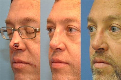 This Client Sought Out Dr Lebeaus Expertise For Reconstruction Of His