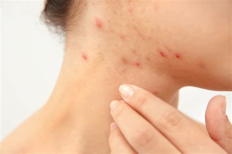 Pimple On Neck Causes Symptoms Treatment Prevention More Healthroid