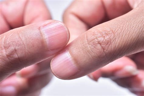 57 Vertical Lines On Nails Vitamin Deficiency Sanscompro Misaucun