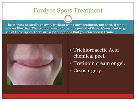 Ppt Fordyce Spots Treatment Powerpoint Presentation Free Download