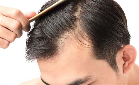 4 the mineral, zinc, also plays a part in hair loss. Is There Anything You Can Do to Prevent Premature Male ...