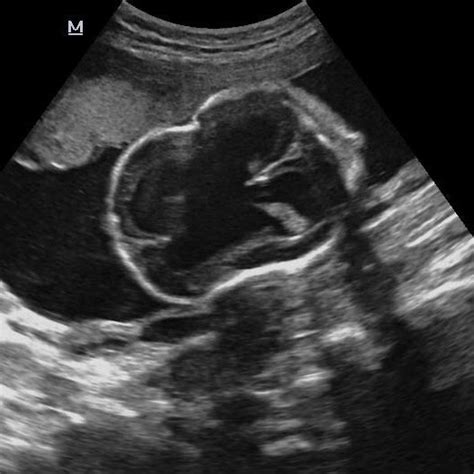 A Ultrasound Image Through The Fetal Thorax Showing Complete