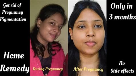 How To Get Rid Of Dark Skin During Pregnancy Pregnancy Pigmentation