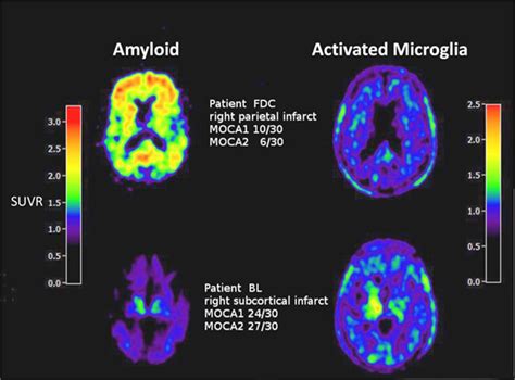Amyloid Burden Neuroinflammation And Links To Cognitive Decline After