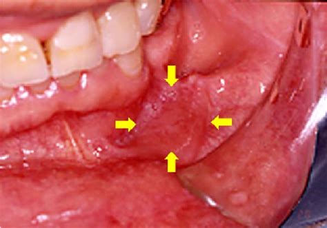 A Case Of Benign Lymphoid Hyperplasia Of Buccal Mucosa Semantic Scholar