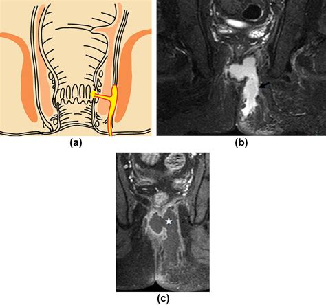 Mri Of Perianal Fistulae A Pictorial Kaleidoscope Clinical Radiology