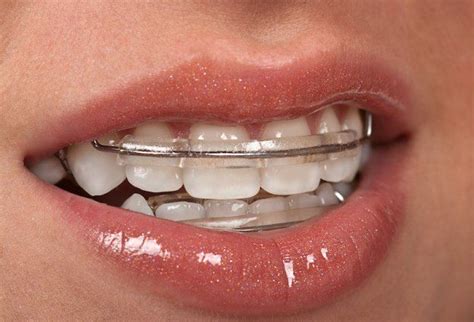 Dental Retainers My Dental Practice Website