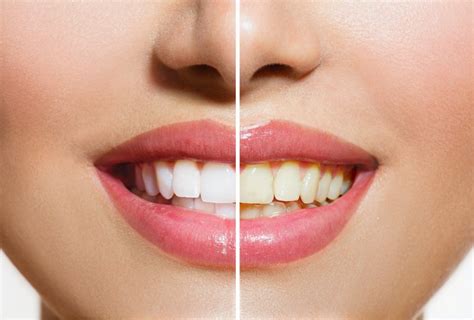 What Are The Benefits Of Professional Teeth Whitening Kwon Dental