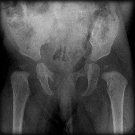 Pelvic Xray Normal Different Ages Image