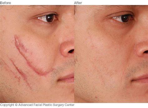 Scar Revision Dallas Advanced Facial Plastic Surgery Center