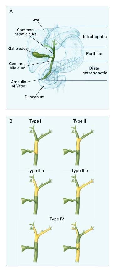 We did not find results for: Biliary Tract Cancers | NEJM