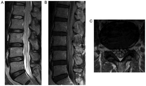 Primary Cauda Equina Lymphoma Diagnosed By Nerve Biopsy A Case Report