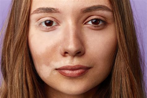 Everything You Need To Know About Pigmentation By Influennzclinic