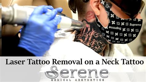 Watch This Laser Tattoo Removal On A Black Neck Tattoo Youtube