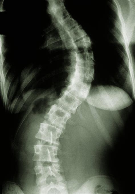 X Ray Showing Scoliosis Curvature Of The Spine Photograph By Medical Photo Nhs Lothianscience
