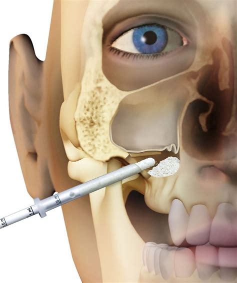 Sinus Lift Surgery For Dental Implants Omnia Dental Clinic