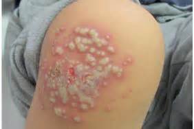 Chaque individu a une réaction et un. Infections herpétiques de localisations inhabituelles chez ...