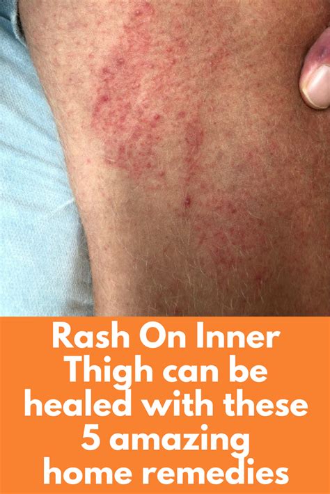 Rash On Inner Thigh Can Be Healed With These 5 Amazing Home Remedies
