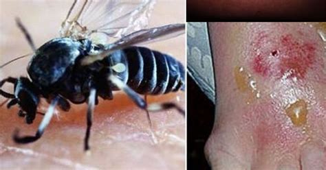 Swarms Of Biting Flies Invading Uk Leaving People With Groin Swelling