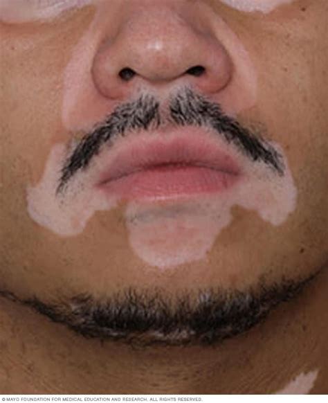 Vitiligo Symptoms And Causes Mayo Clinic